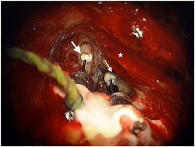 New Considerations for a Totally Implantable Active Middle Ear Implant